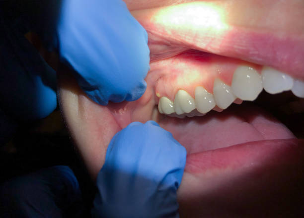 Best Emergency Wisdom Teeth Removal in Lansing, KS